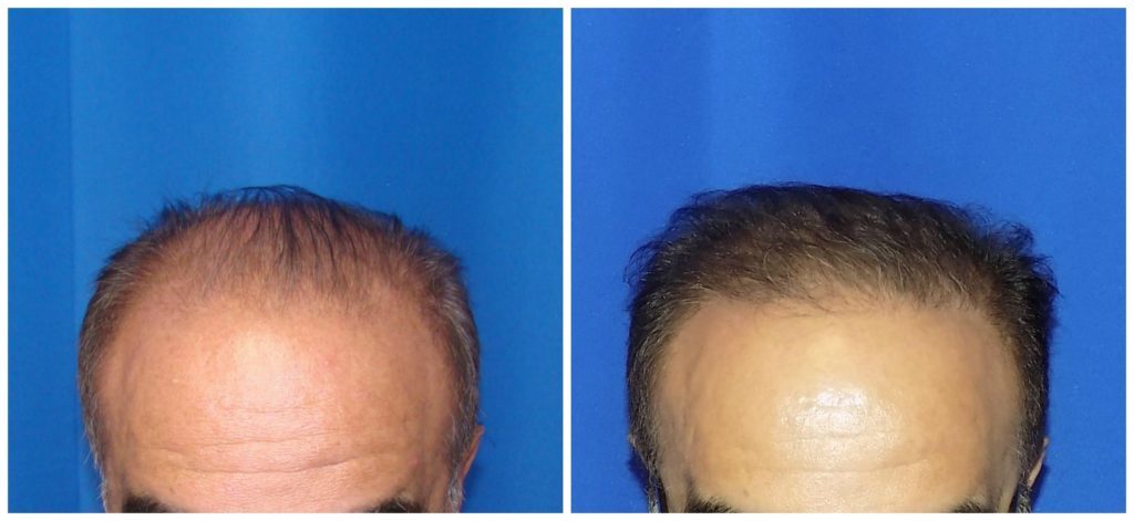 NeoGraft Before & After Patient #181