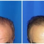 NeoGraft Before & After Patient #181