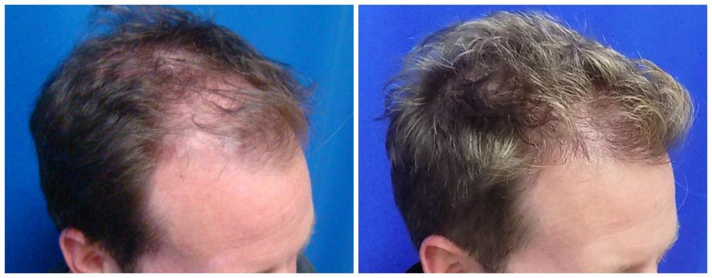 NeoGraft Before & After Patient #183