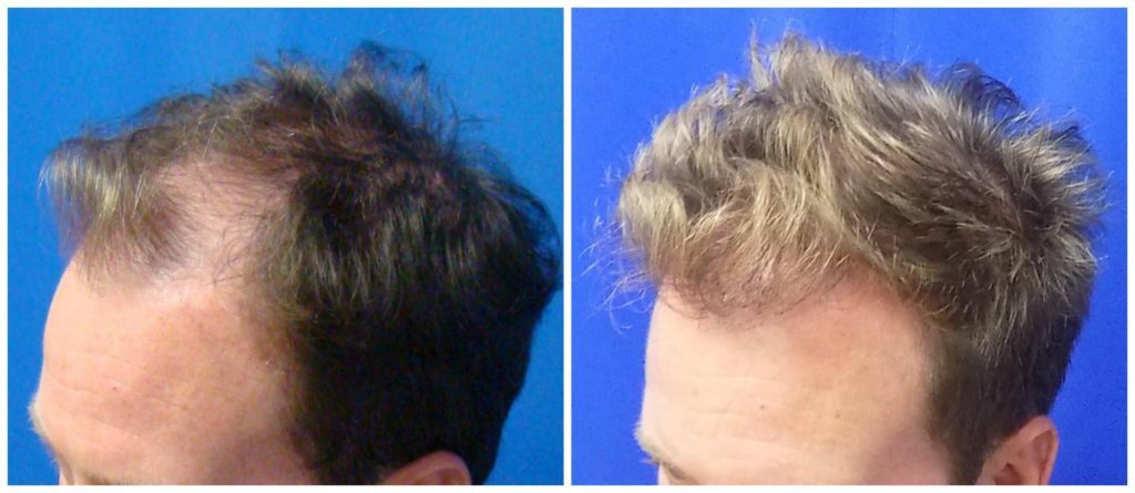 NeoGraft Before & After Patient #183