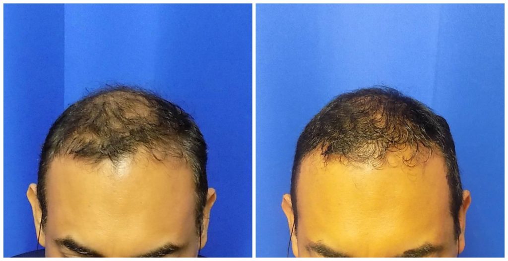 NeoGraft Before & After Patient #224