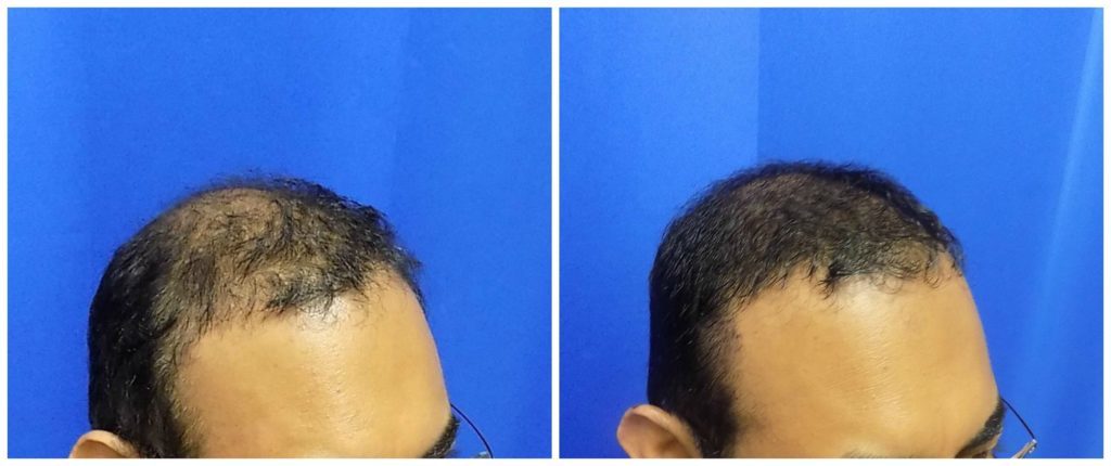 NeoGraft Before & After Patient #224