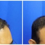 NeoGraft Before & After Patient #224