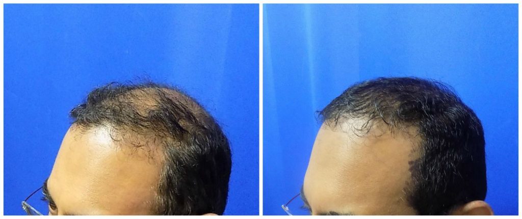 NeoGraft Before & After Patient #224