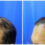 NeoGraft Before & After Patient #224