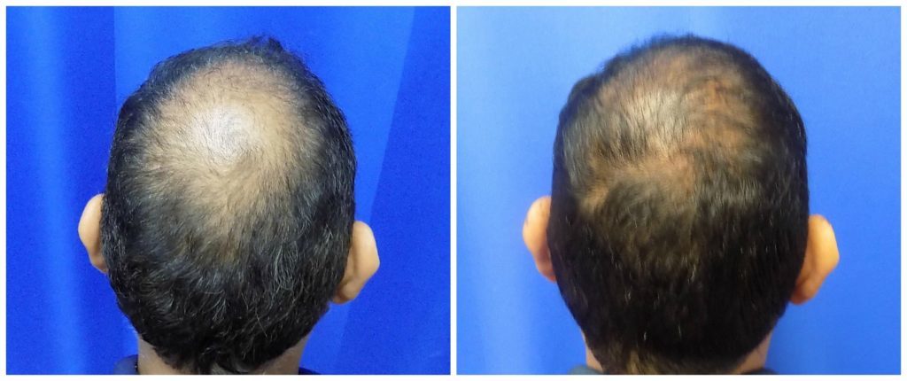 NeoGraft Before & After Patient #224