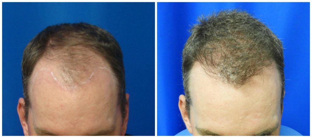 NeoGraft Before & After Patient #229