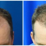 NeoGraft Before & After Patient #229