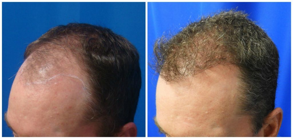 NeoGraft Before & After Patient #229
