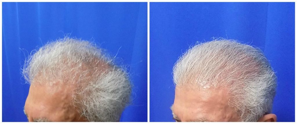 NeoGraft Before & After Patient #232
