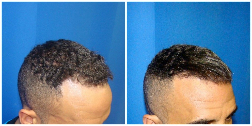 NeoGraft Before & After Patient #191