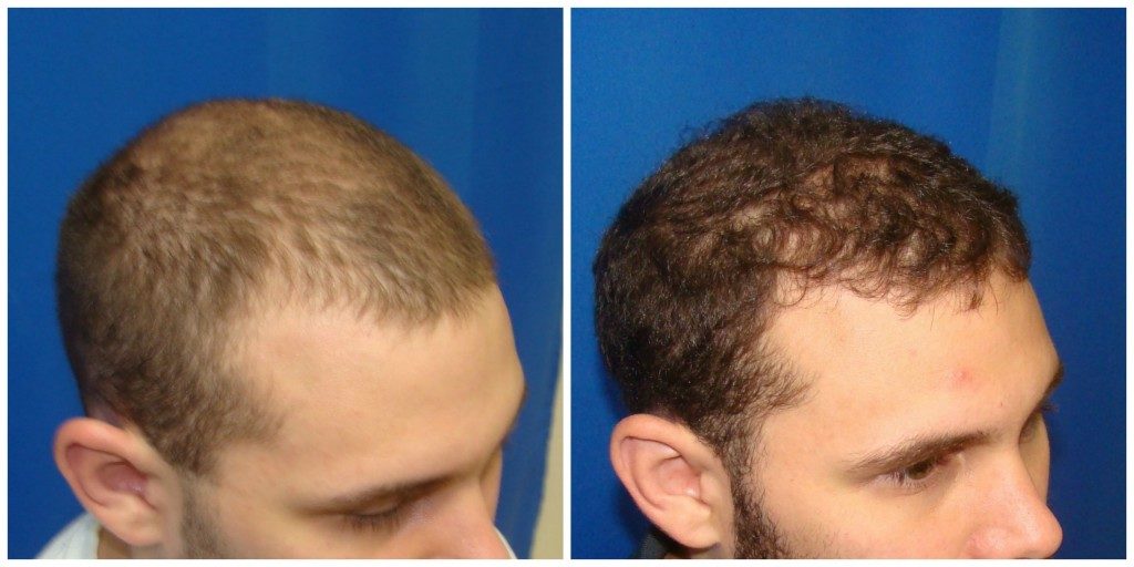 NeoGraft Before & After Patient #187