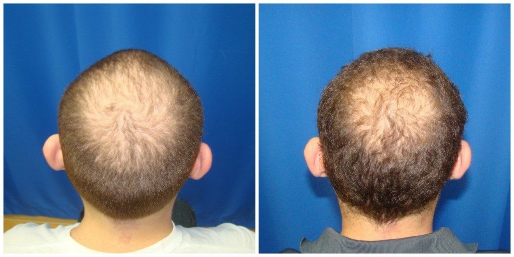 Patient #187 NeoGraft Before and After Photos Houston, TX - Plastic Surgery  Gallery Dr. Goran Jezic