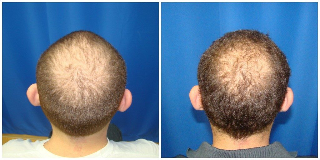 NeoGraft Before & After Patient #187