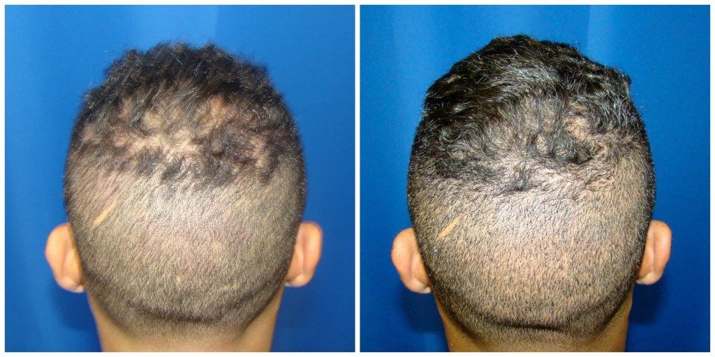 NeoGraft Before & After Patient #191