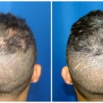 NeoGraft Before & After Patient #191