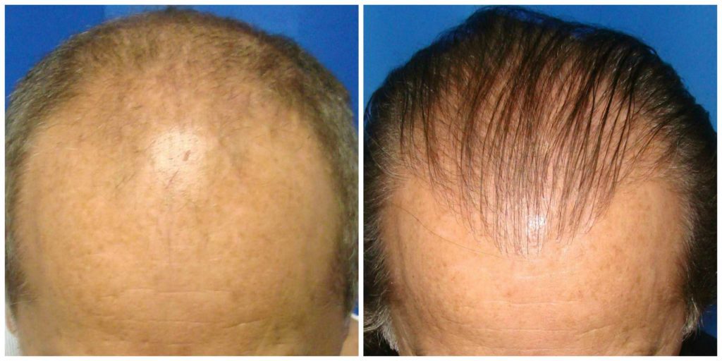 NeoGraft Before & After Patient #204