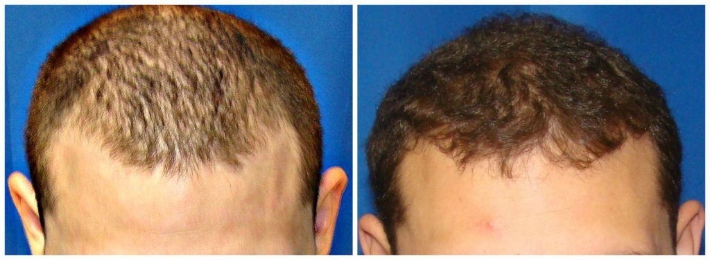 NeoGraft Before & After Patient #210