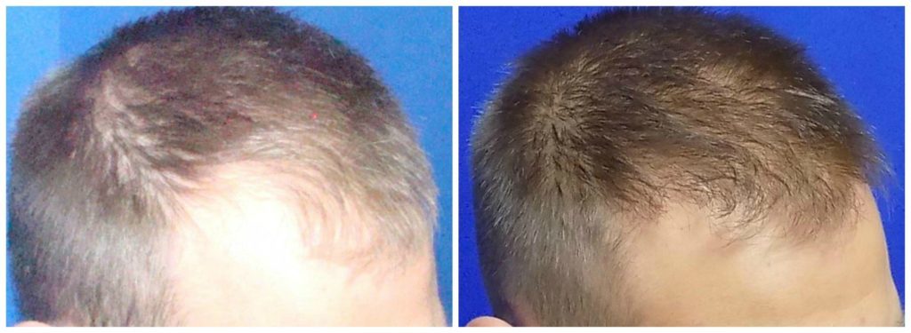 NeoGraft Before & After Patient #215