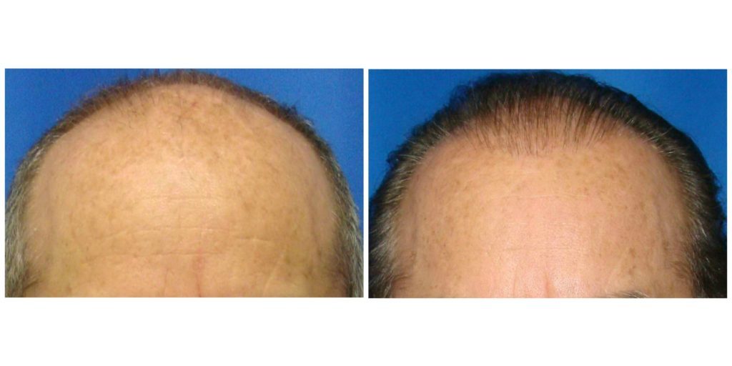 NeoGraft Before & After Patient #204