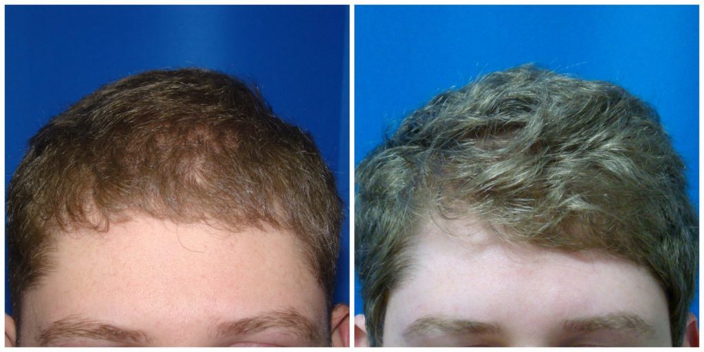 NeoGraft Before & After Patient #220