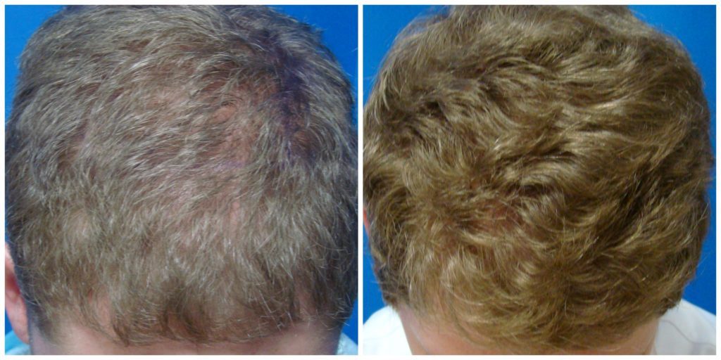 NeoGraft Before & After Patient #222