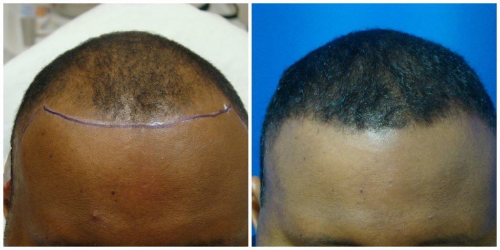 NeoGraft Before & After Patient #195