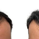 Hair Transplants Before & After Patient #694