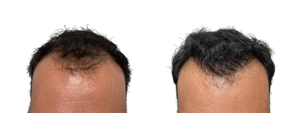 Hair Transplants Before & After Patient #694