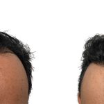 Hair Transplants Before & After Patient #704