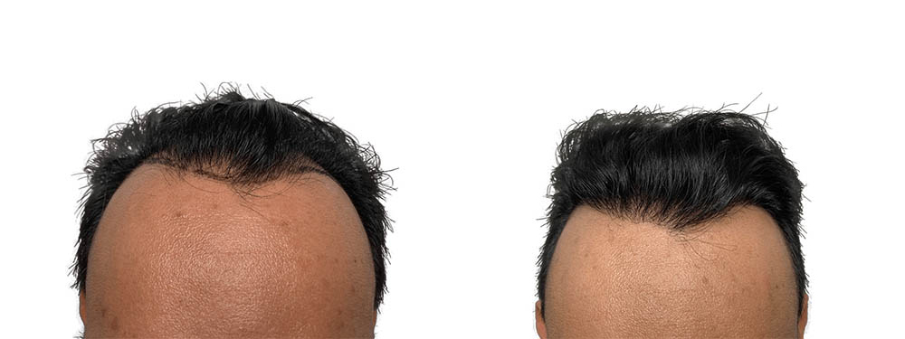 Hair Transplants Before & After Patient #704