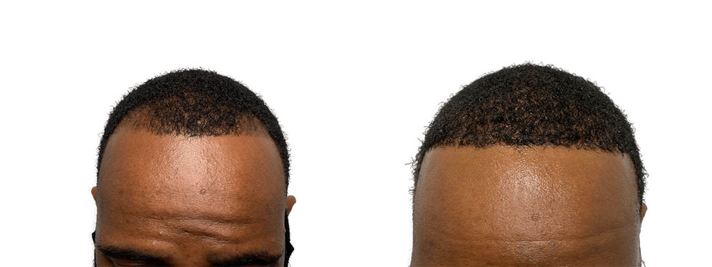 Hair Transplants Before & After Patient #709