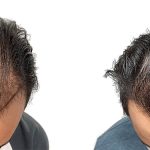 Hair Transplants Before & After Patient #714