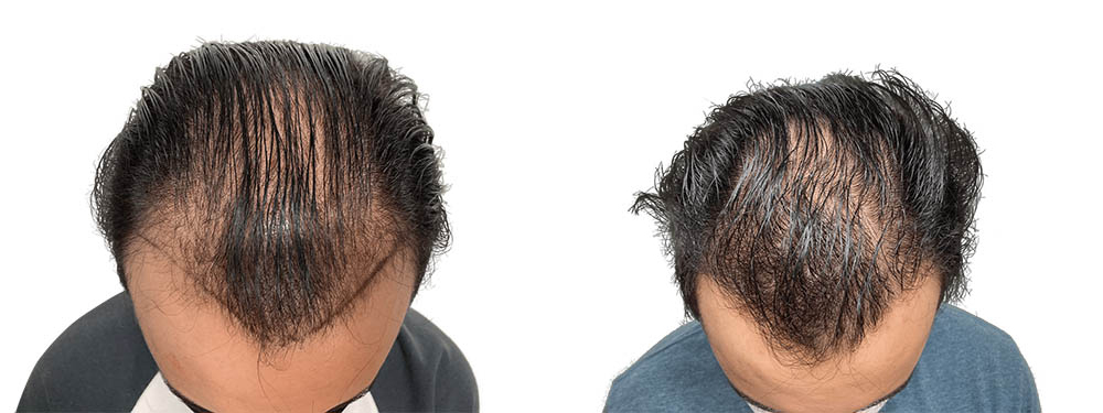 Hair Transplants Before & After Patient #714