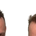 Hair Transplants Before & After Patient #719