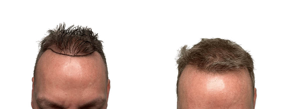 Hair Transplants Before & After Patient #719