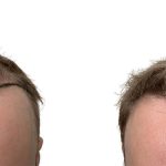 Hair Transplants Before & After Patient #723