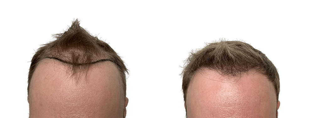 Hair Transplants Before & After Patient #723