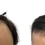 Hair Transplants Before & After Patient #728