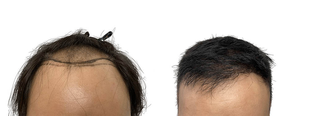 Hair Transplants Before & After Patient #728