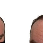Hair Transplants Before & After Patient #733