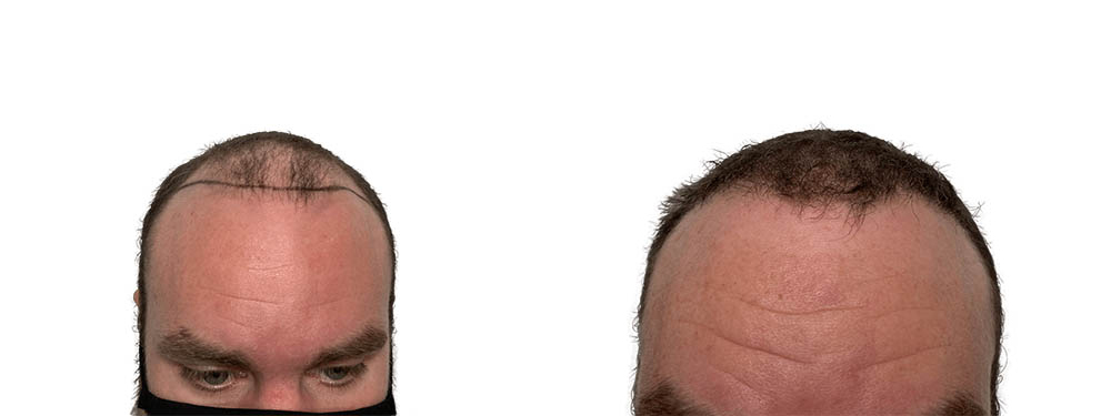 Hair Transplants Before & After Patient #733