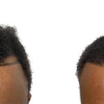 Hair Transplants Before & After Patient #738