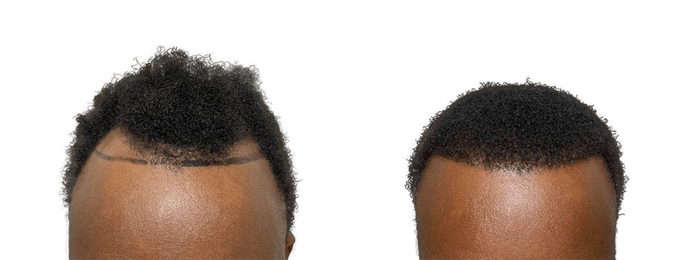 Hair Transplants Before & After Patient #738