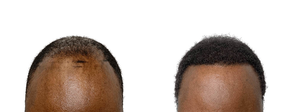 Hair Transplants Before & After Patient #743