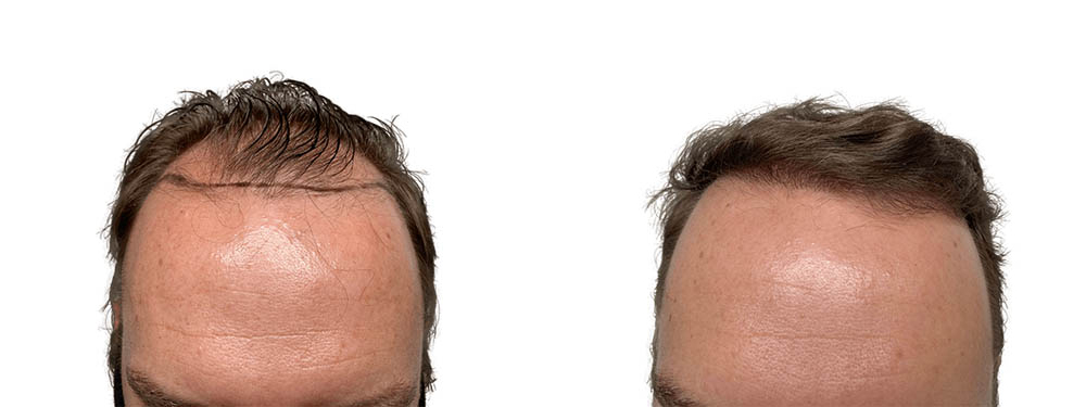 Hair Transplants Before & After Patient #748