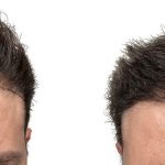 Hair Transplants Before & After Patient #753