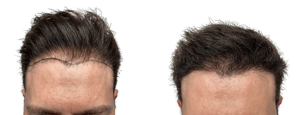 Hair Transplants Before & After Patient #753