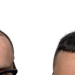 Hair Transplants Before & After Patient #757