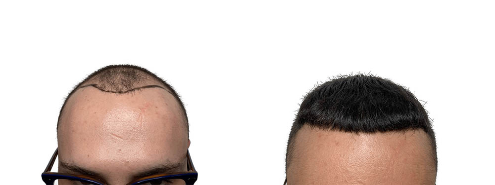 Hair Transplants Before & After Patient #757